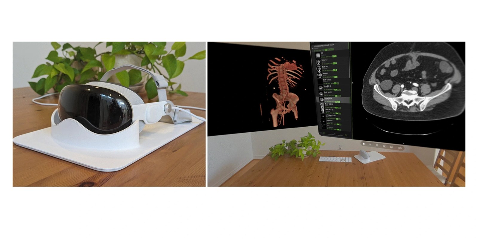 New Apple Vision Pro study reveals promising performance in radiology